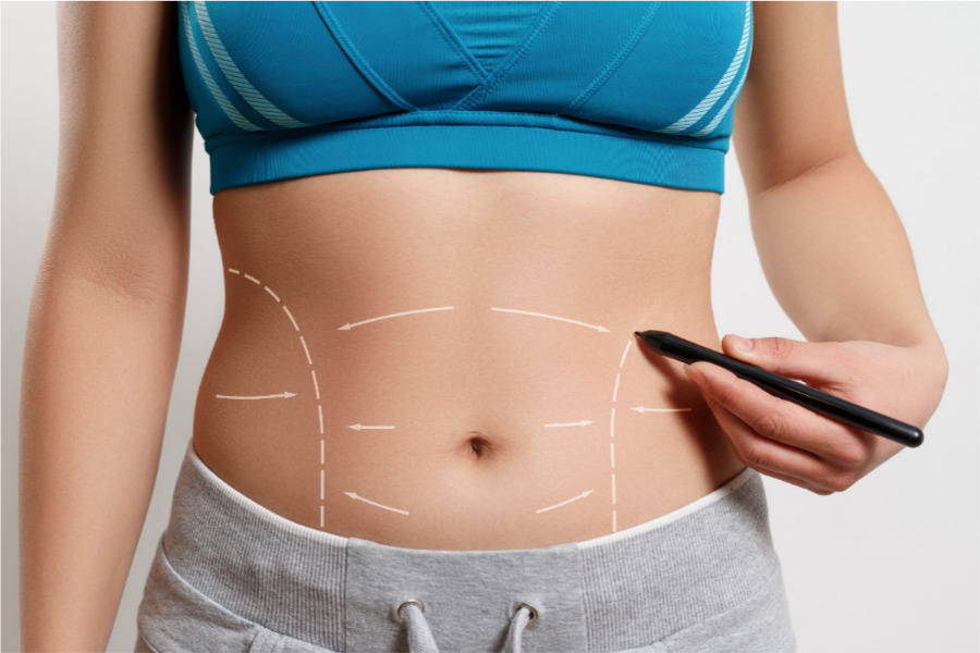 health connection, cirugía, plástica, abdominoplastía