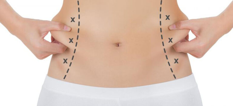 cirugía, contorno, corporal, lipo, lipoescultura