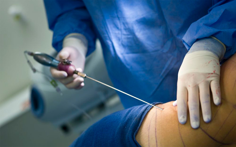 health connection, cirugía, plástica, liposucción